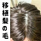 髪の毛の植毛あり